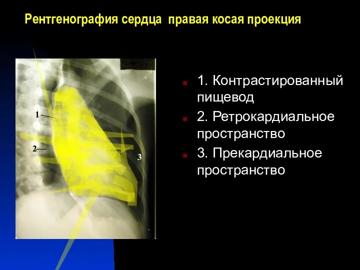 Рентгенография сердца правая косая проекция 1. Контрастированный пищевод 2. Ретрокардиальное