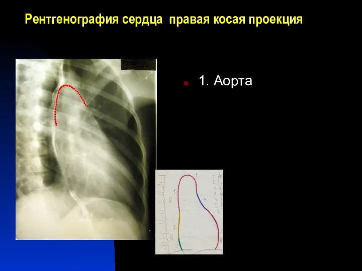 Рентгенография сердца правая косая проекция 1. Аорта 1 3 5 7