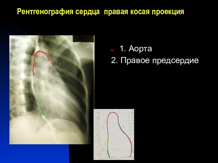 Рентгенография сердца правая косая проекция 1. Аорта 2. Правое предсердие 1 3 5 7