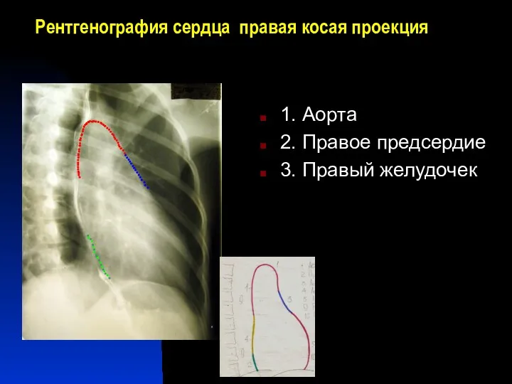 Рентгенография сердца правая косая проекция 1. Аорта 2. Правое предсердие