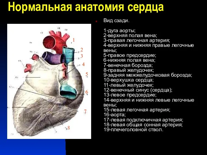 Нормальная анатомия сердца Вид сзади. 1-дуга аорты; 2-верхняя полая вена;