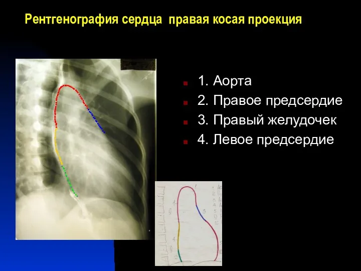 Рентгенография сердца правая косая проекция 1. Аорта 2. Правое предсердие