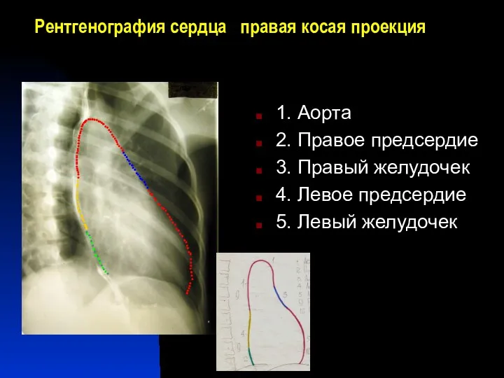 Рентгенография сердца правая косая проекция 1. Аорта 2. Правое предсердие