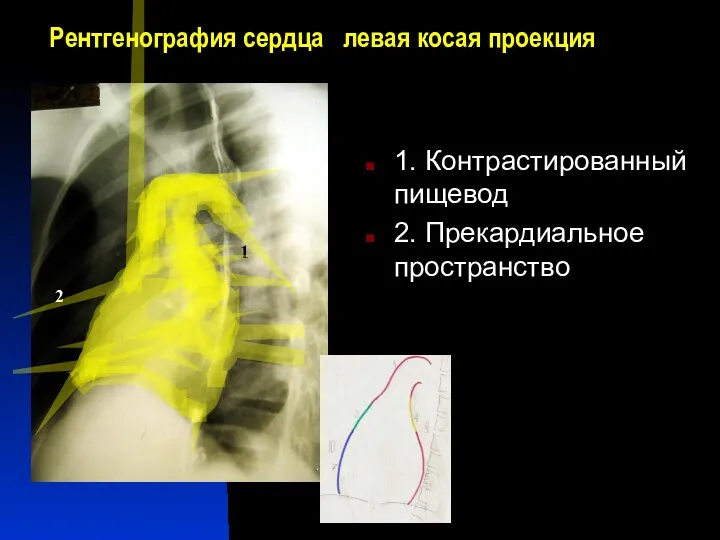 Рентгенография сердца левая косая проекция 1. Контрастированный пищевод 2. Прекардиальное