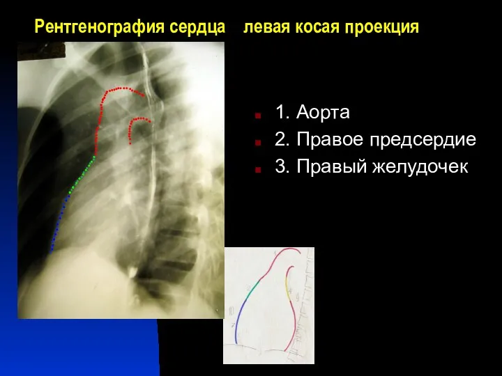 Рентгенография сердца левая косая проекция 1. Аорта 2. Правое предсердие