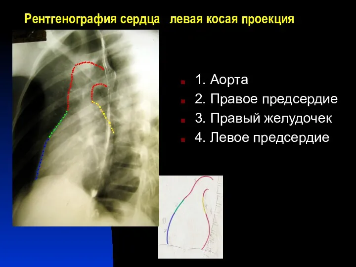 Рентгенография сердца левая косая проекция 1. Аорта 2. Правое предсердие