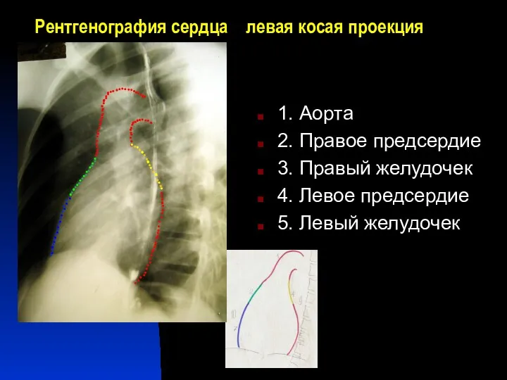 Рентгенография сердца левая косая проекция 1. Аорта 2. Правое предсердие