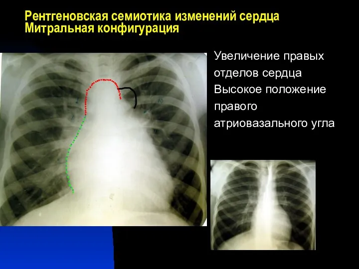 Рентгеновская семиотика изменений сердца Митральная конфигурация Увеличение правых отделов сердца Высокое положение правого атриовазального угла