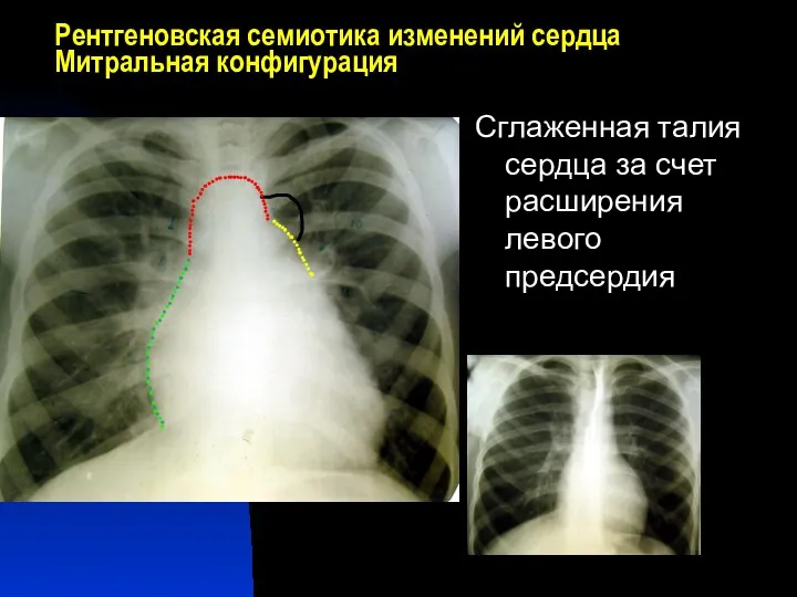 Рентгеновская семиотика изменений сердца Митральная конфигурация Сглаженная талия сердца за счет расширения левого предсердия