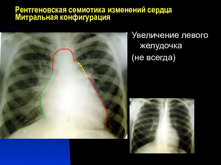 Рентгеновская семиотика изменений сердца Митральная конфигурация Увеличение левого желудочка (не всегда)