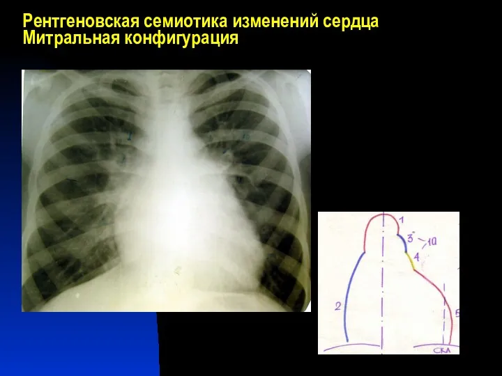 Рентгеновская семиотика изменений сердца Митральная конфигурация