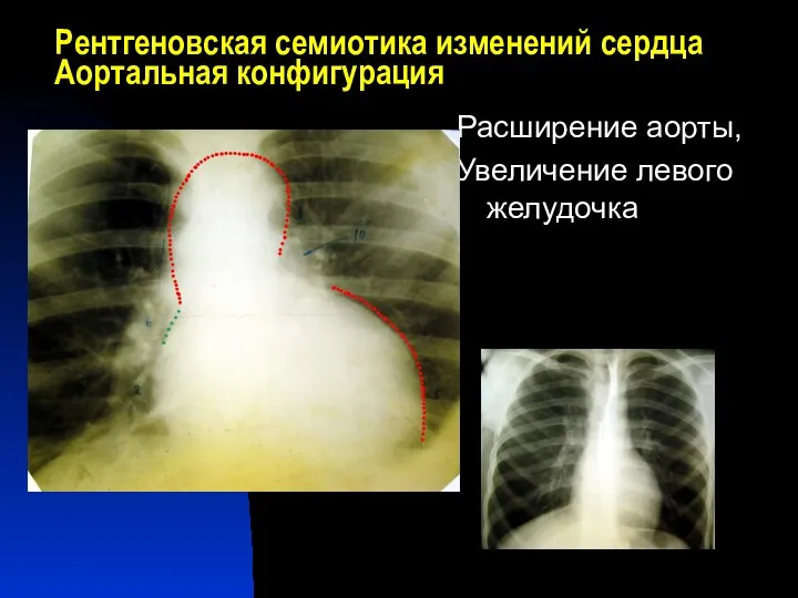 Рентгеновская семиотика изменений сердца Аортальная конфигурация Расширение аорты, Увеличение левого желудочка