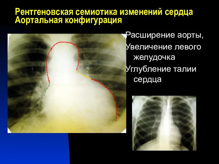 Рентгеновская семиотика изменений сердца Аортальная конфигурация Расширение аорты, Увеличение левого желудочка Углубление талии сердца