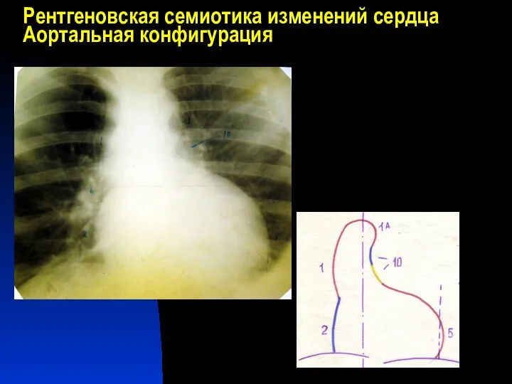 Рентгеновская семиотика изменений сердца Аортальная конфигурация