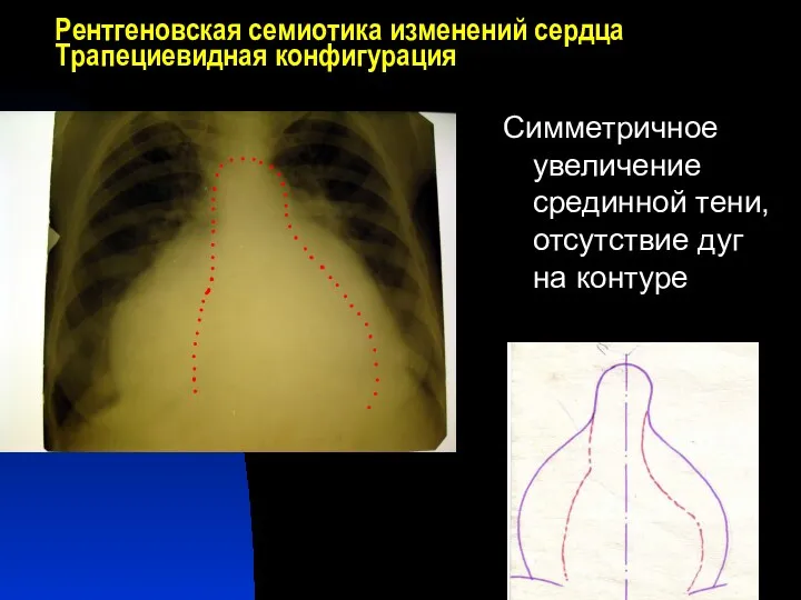 Рентгеновская семиотика изменений сердца Трапециевидная конфигурация Симметричное увеличение срединной тени, отсутствие дуг на контуре