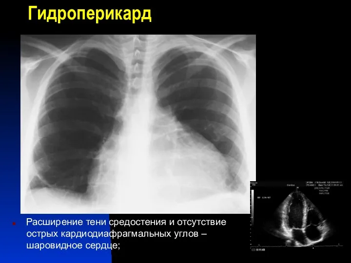 Гидроперикард Расширение тени средостения и отсутствие острых кардиодиафрагмальных углов – шаровидное сердце;