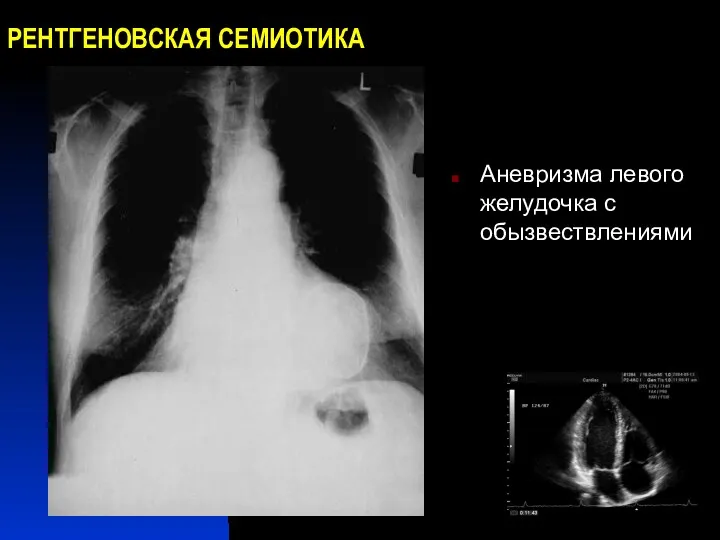 РЕНТГЕНОВСКАЯ СЕМИОТИКА Аневризма левого желудочка с обызвествлениями