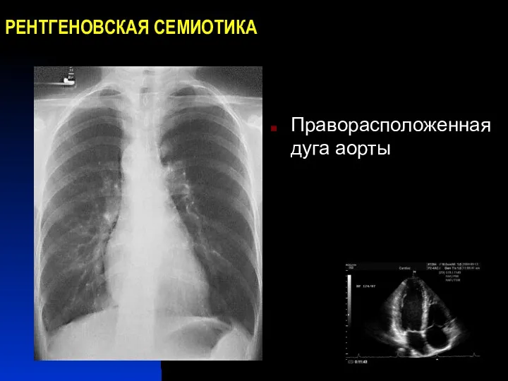 РЕНТГЕНОВСКАЯ СЕМИОТИКА Праворасположенная дуга аорты