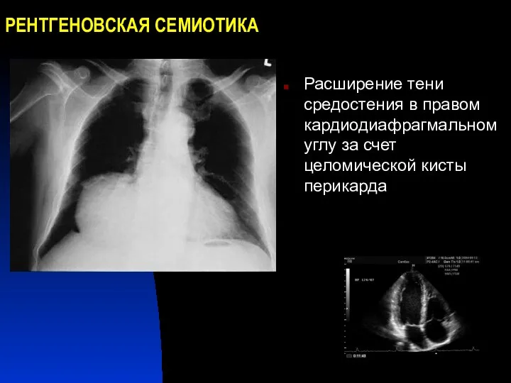 РЕНТГЕНОВСКАЯ СЕМИОТИКА Расширение тени средостения в правом кардиодиафрагмальном углу за счет целомической кисты перикарда