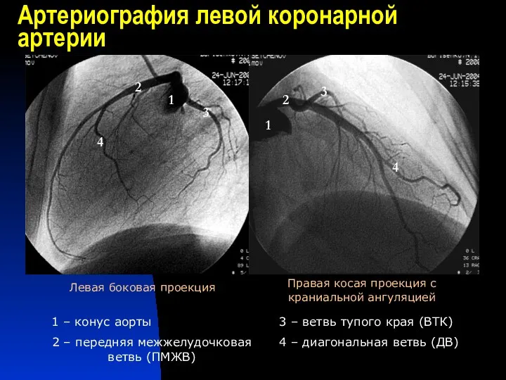 Артериография левой коронарной артерии 1 – конус аорты 2 –