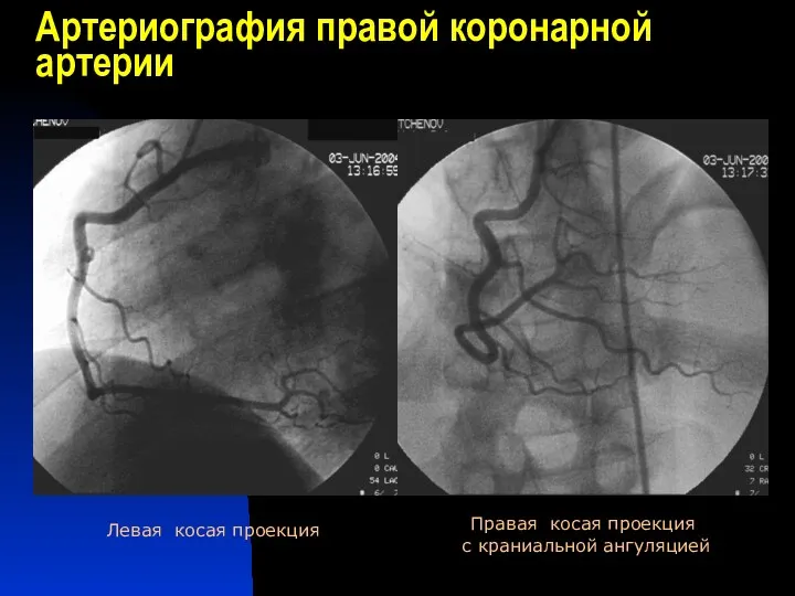 Артериография правой коронарной артерии