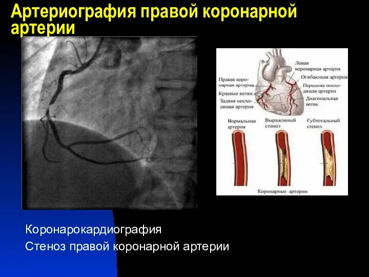 Артериография правой коронарной артерии Коронарокардиография Стеноз правой коронарной артерии