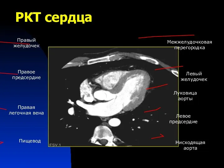 РКТ сердца Левый желудочек Левое предсердие Луковица аорты Правое предсердие