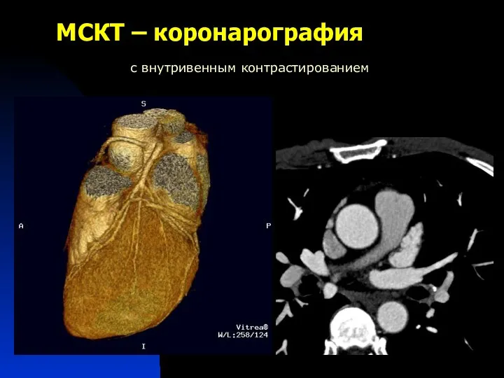 МСКТ – коронарография с внутривенным контрастированием