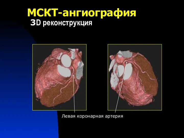 МСКТ-ангиография 3D реконструкция Левая коронарная артерия