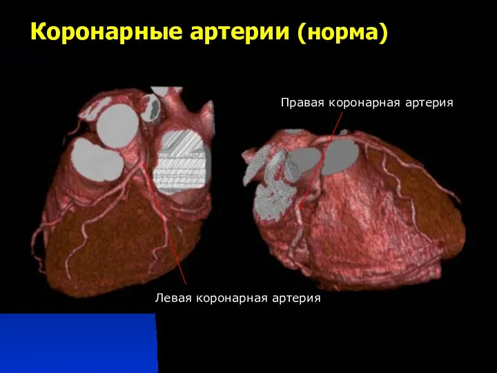 Коронарные артерии (норма) Левая коронарная артерия Правая коронарная артерия