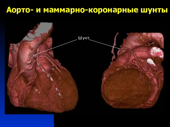 Аорто- и маммарно-коронарные шунты Шунт