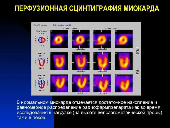 ПЕРФУЗИОННАЯ СЦИНТИГРАФИЯ МИОКАРДА В нормальном миокарде отмечается достаточное накопление и