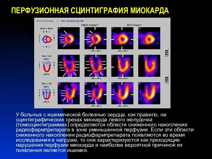 ПЕРФУЗИОННАЯ СЦИНТИГРАФИЯ МИОКАРДА У больных с ишемической болезнью сердца, как