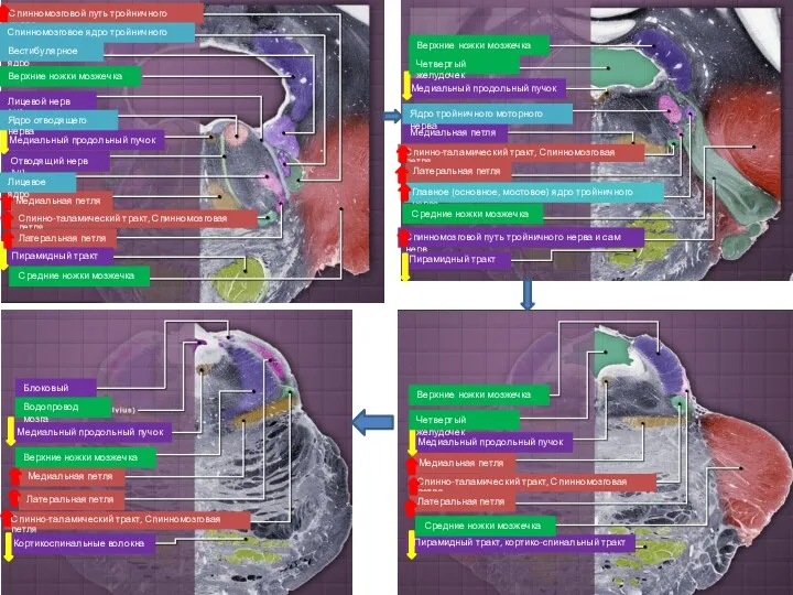 Спинномозговой путь тройничного нерва Лицевой нерв (VII) Медиальный продольный пучок