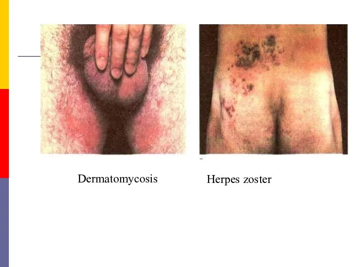 Dermatomycosis Herpes zoster
