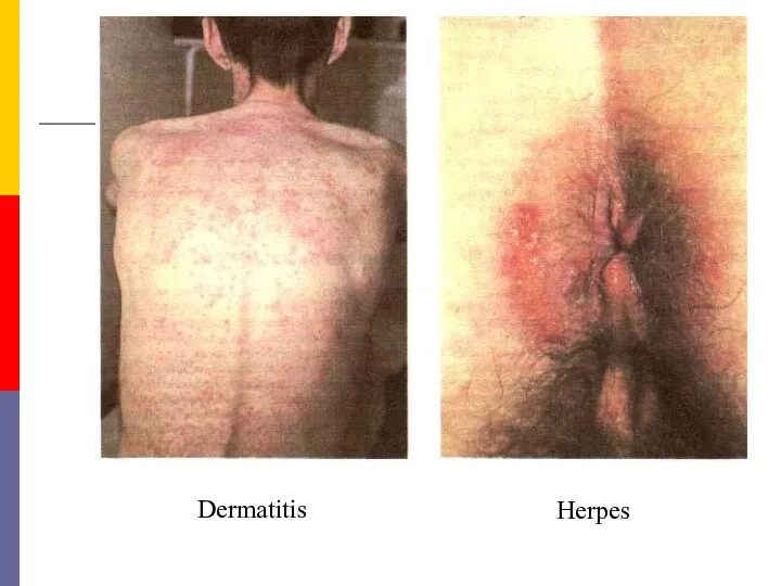 Dermatitis Herpes