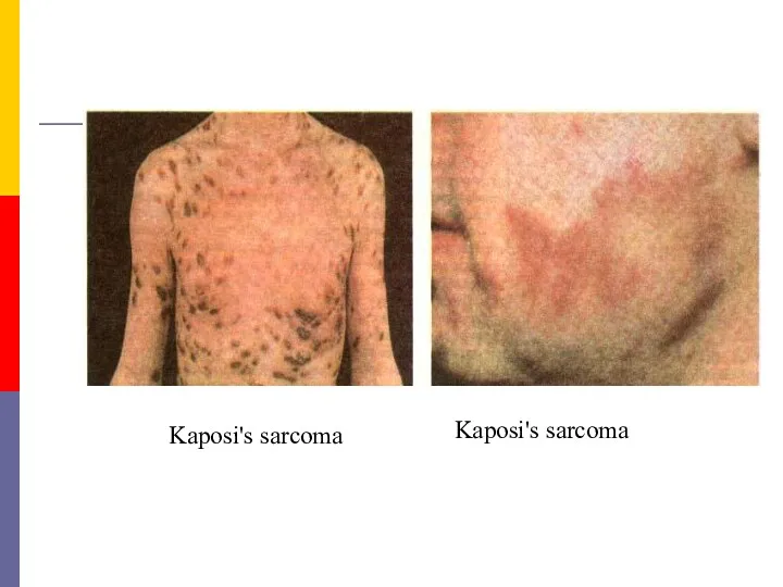 Kaposi's sarcoma Kaposi's sarcoma