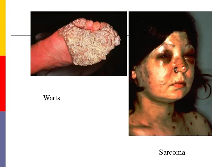 Warts Sarcoma