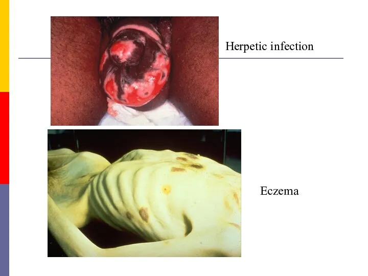 Herpetic infection Еczema