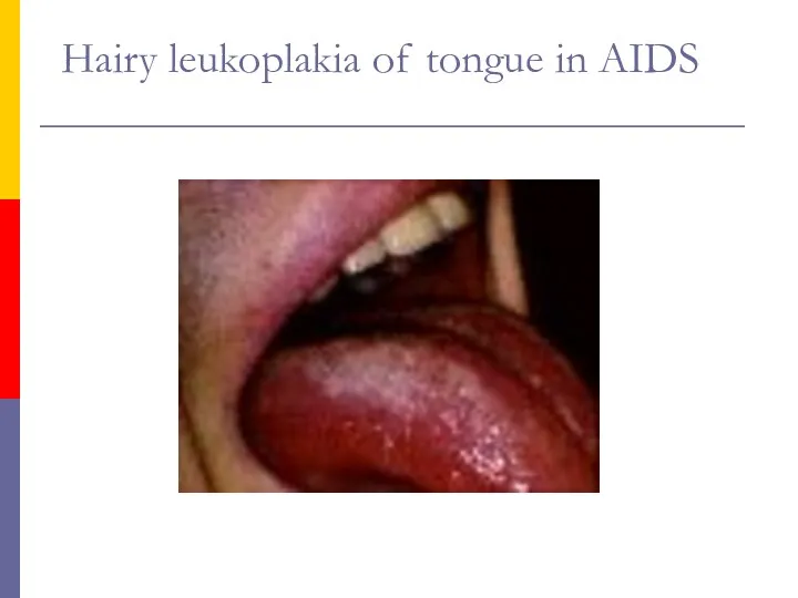 Hairy leukoplakia of tongue in AIDS
