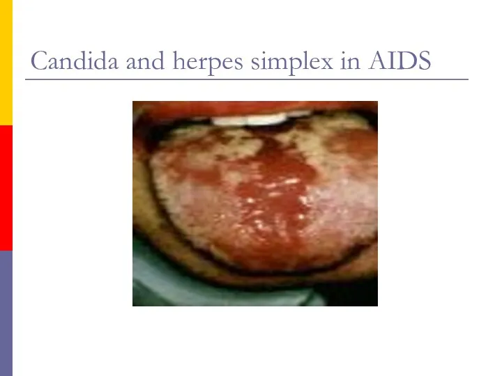 Candida and herpes simplex in AIDS