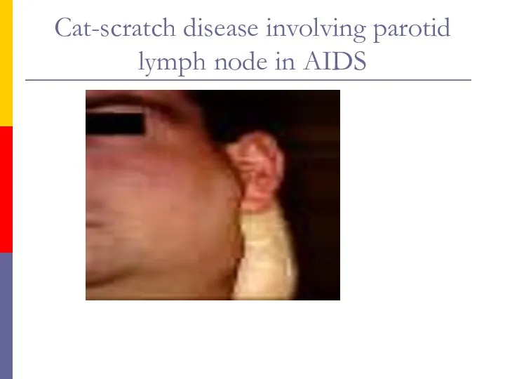 Cat-scratch disease involving parotid lymph node in AIDS