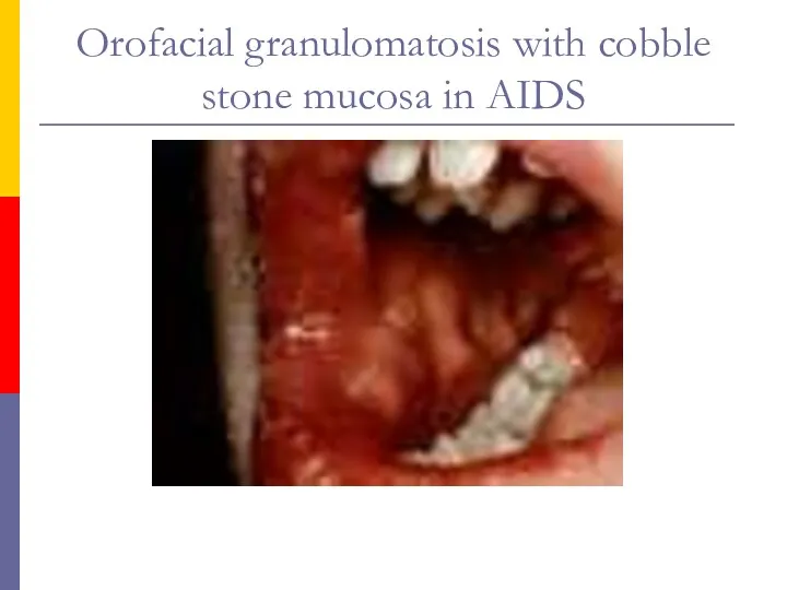 Orofacial granulomatosis with cobble stone mucosa in AIDS