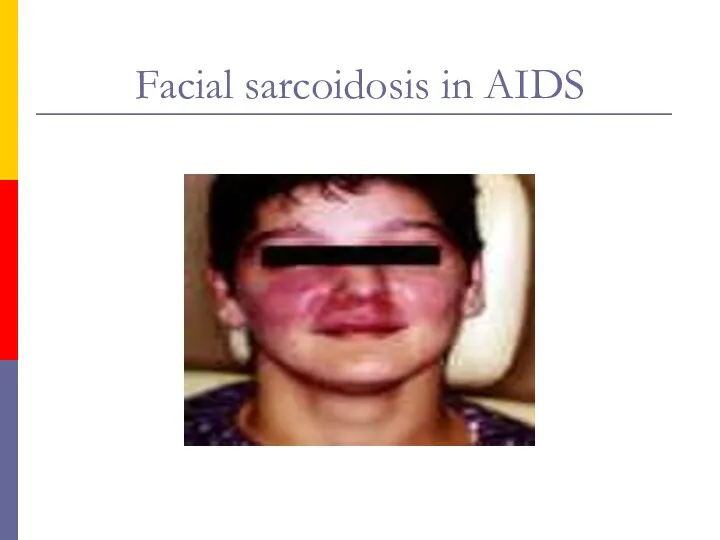 Facial sarcoidosis in AIDS