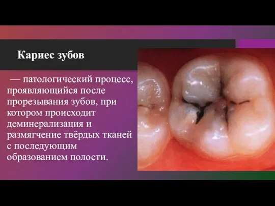 Кариес зубов — патологический процесс, проявляющийся после прорезывания зубов, при