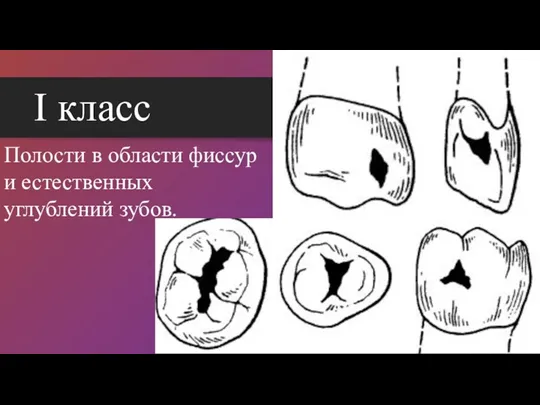 I класс Полости в области фиссур и естественных углублений зубов.