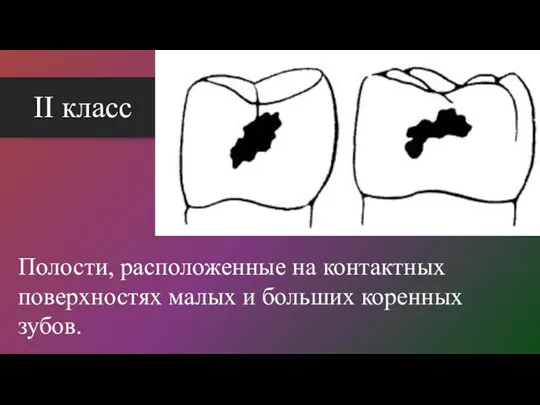 II класс Полости, расположенные на контактных поверхностях малых и больших коренных зубов.