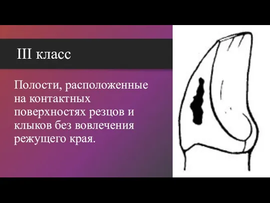 III класс Полости, расположенные на контактных поверхностях резцов и клыков без вовлечения режущего края.