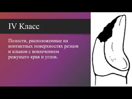 IV Класс Полости, расположенные на контактных поверхностях резцов и клыков с вовлечением режущего края и углов.