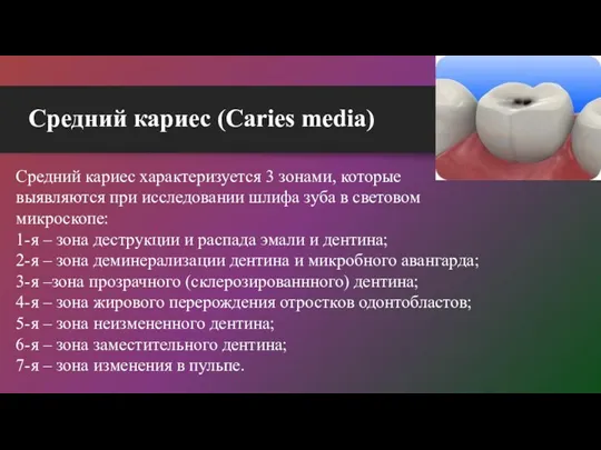 Средний кариес (Caries media) Средний кариес характеризуется 3 зонами, которые